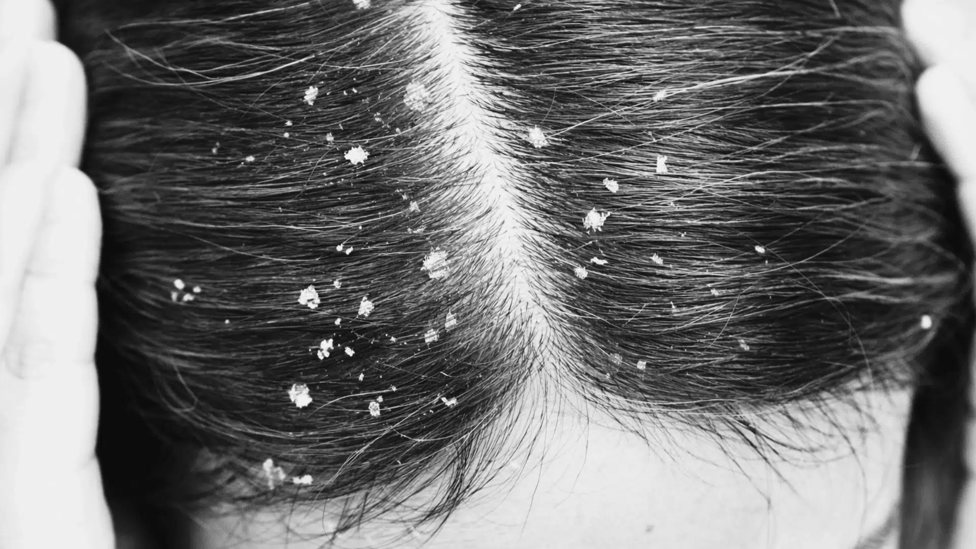Dandruff