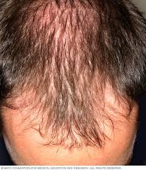 Patchy Scalp